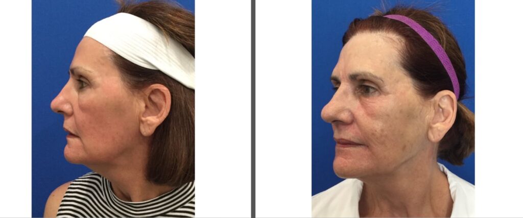 Laser Resurfacing Before and After Pictures Melbourne, FL