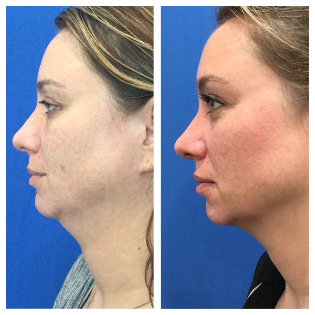 Kybella® Before and After Pictures Melbourne, FL
