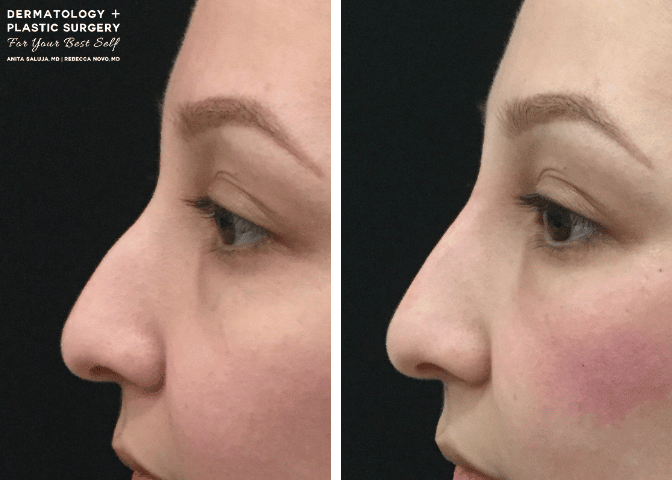 Liquid Rhinoplasty Before and After Pictures Melbourne, FL