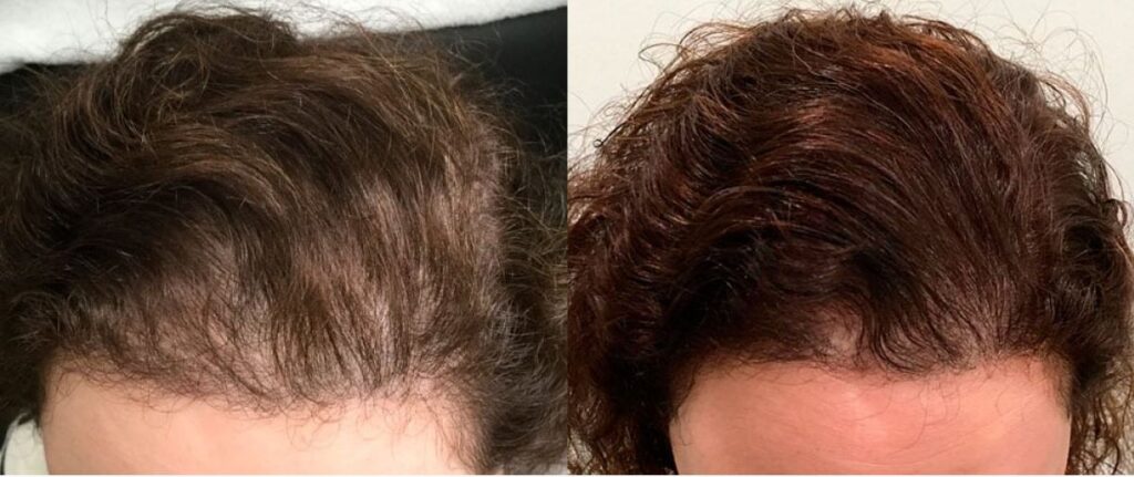 PRP & PRF Treatments Before and After Pictures Melbourne, FL