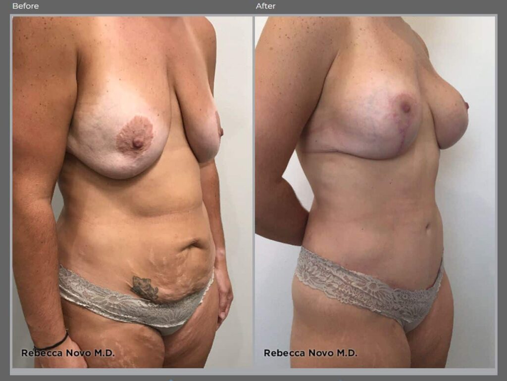 Tummy Tuck 