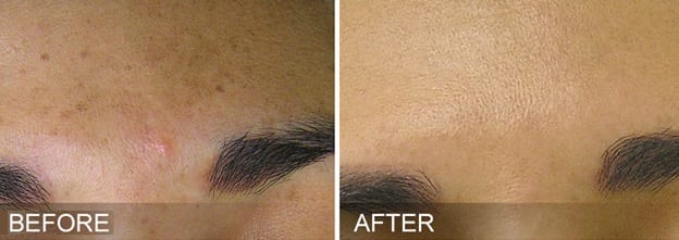 Laser Treatments Before and After Pictures Melbourne, FL