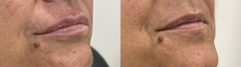 Patient #62748 Before and After Photos Melbourne, FL